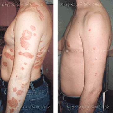 Łuszczyca na plecach - przed i po leczen iu preparatami Dr Michaels