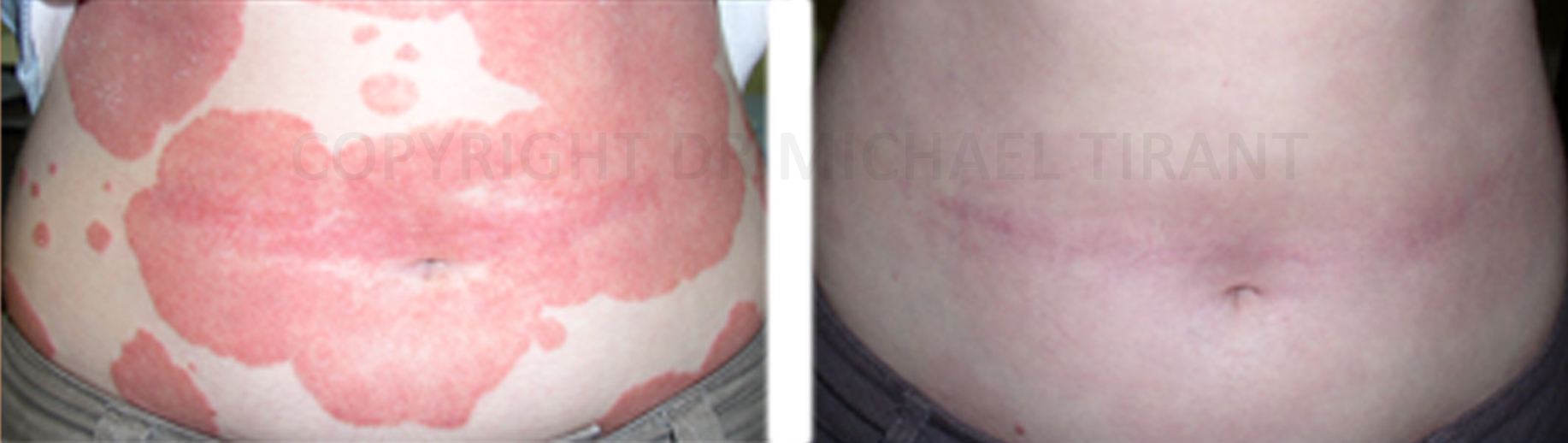 Łuszczyca na plecach - przed i po leczeniu preparatami Dr Michaels
